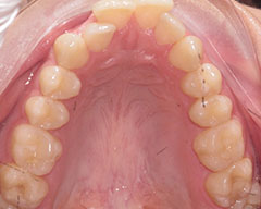 Teeth Before