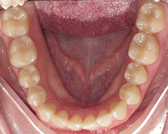 Teeth Before