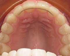 Teeth Before