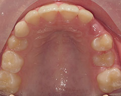 Teeth Before