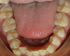 Teeth Before