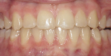 Teeth Before