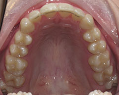 Teeth Before