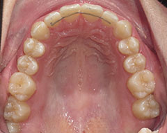 Teeth Before