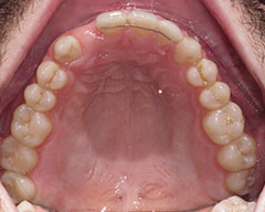Teeth Before
