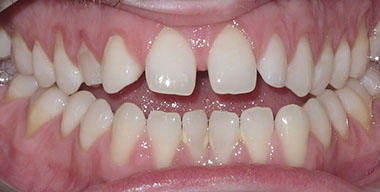 Teeth Before