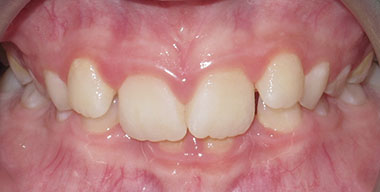 Teeth Before