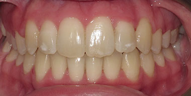 Teeth Before