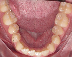 Teeth Before