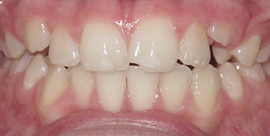 Teeth Before