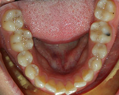 Teeth Before