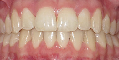 Teeth Before
