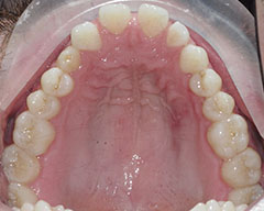 Teeth Before