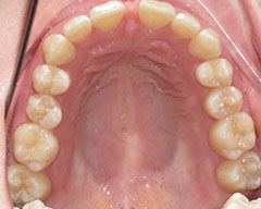 Teeth Before