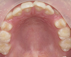 Teeth Before