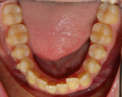 Teeth Before